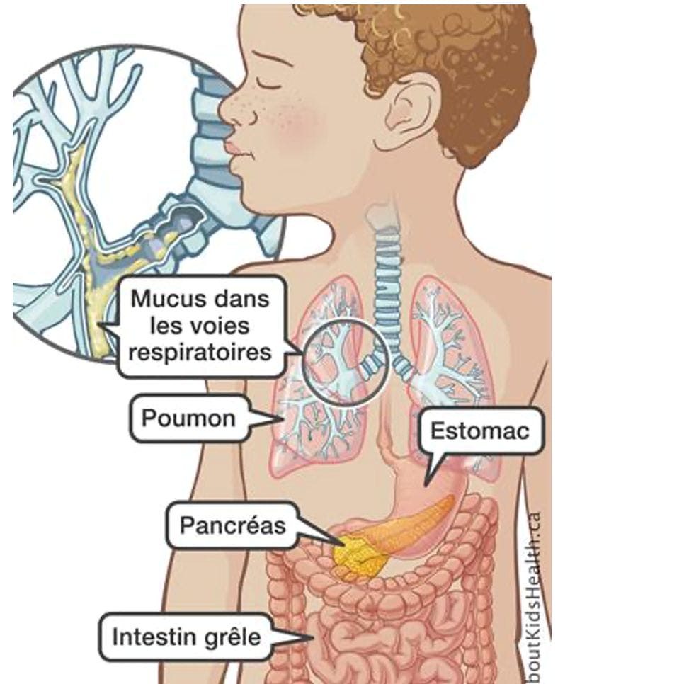 Schéma des symptômes